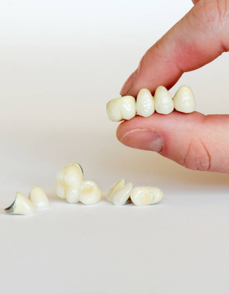 Dental Crowns and Bridges - Tijuana Dental Studio