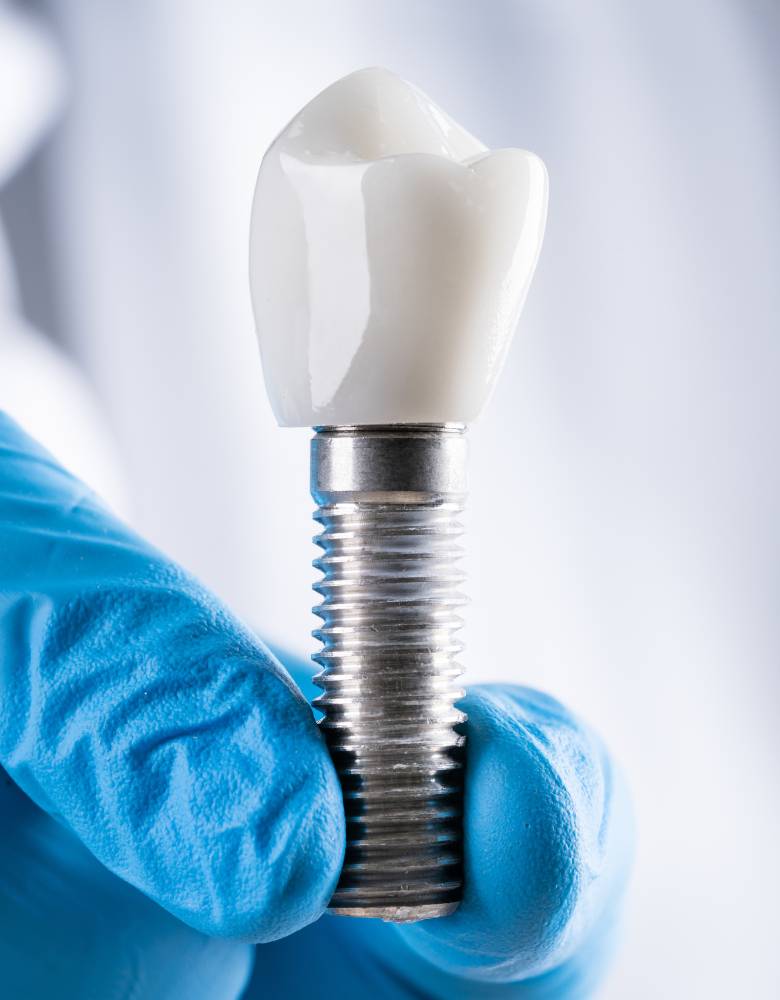 Dental Implants - Tijuana Dental Dental Implants - Tijuana Dental