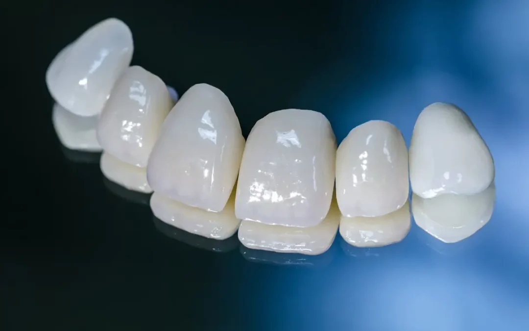 All You Need to Know About Emax Crowns