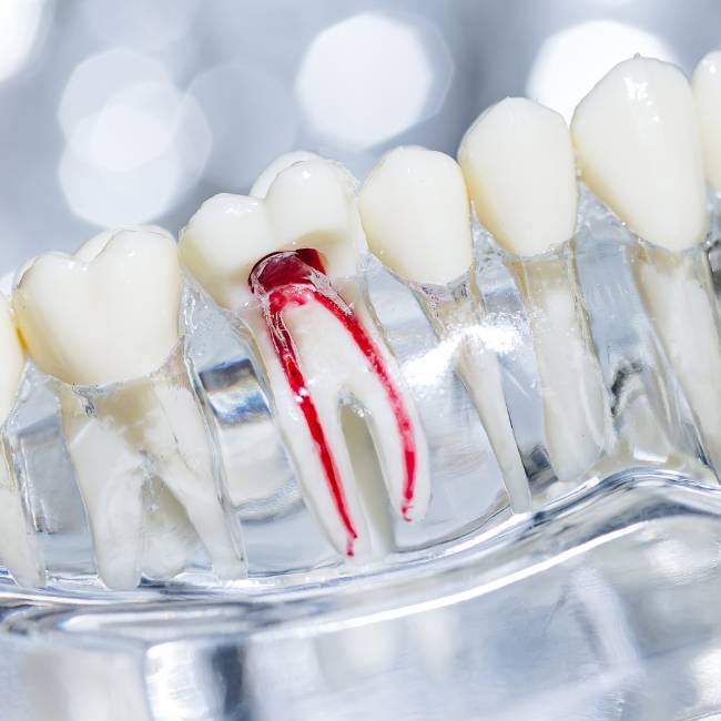 Root Canals - Tijuana Dental Studio