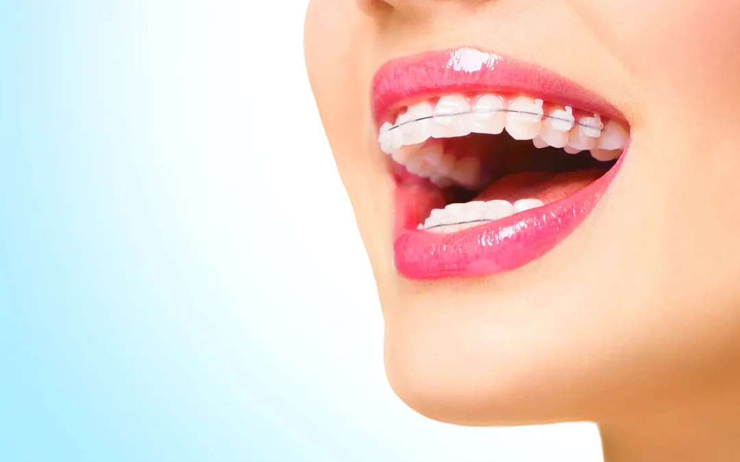 Transforming Smiles with Braces in Tijuana, BC: Affordable Orthodontic Solutions