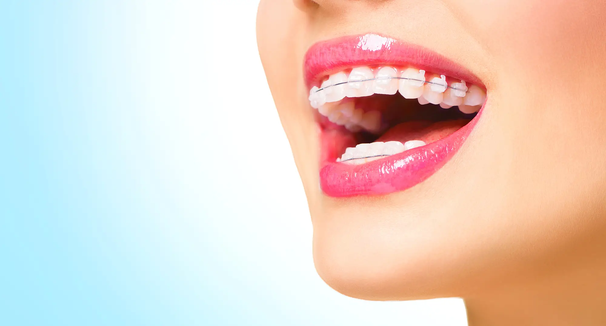 braces-in-tijuana-bc